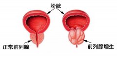 男性尿不出来可能是得了前列腺增生吗?
