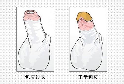 包皮不割有影响吗?